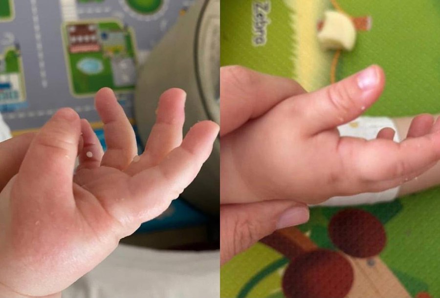Miglioramento della pelle sulla mano